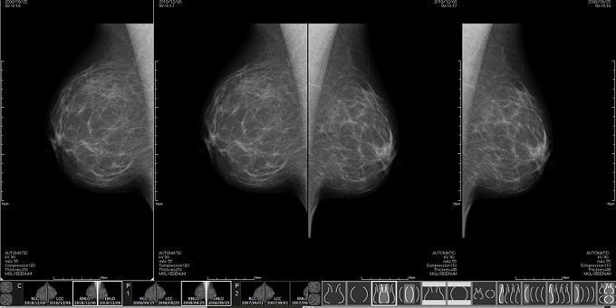 マンモグラフィ